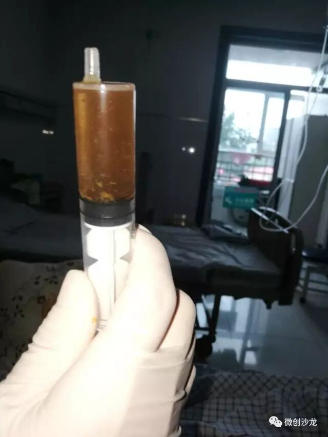 引流管怎么冲管居家护理：引流管看护和简单冲管_https://www.jmylbn.com_新闻资讯_第15张