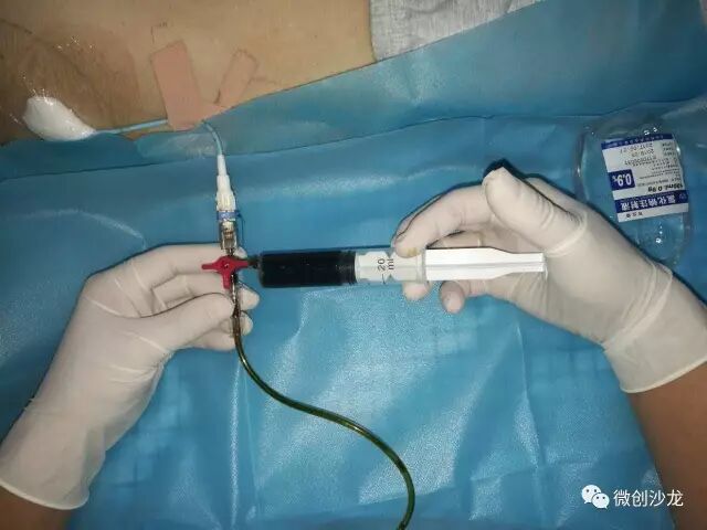 引流管怎么冲管居家护理：引流管看护和简单冲管_https://www.jmylbn.com_新闻资讯_第14张