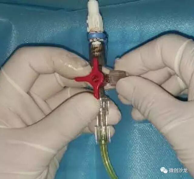 引流管怎么冲管居家护理：引流管看护和简单冲管_https://www.jmylbn.com_新闻资讯_第10张