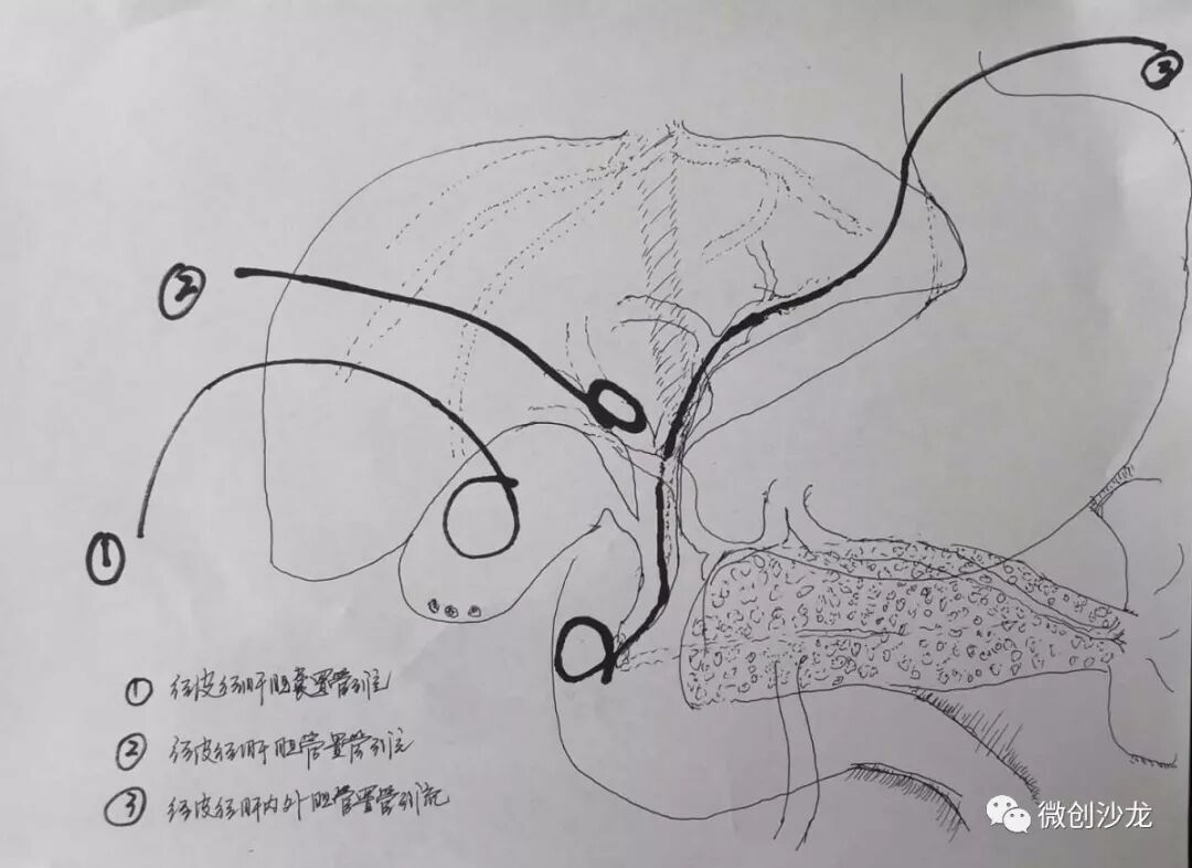 引流管怎么冲管居家护理：引流管看护和简单冲管_https://www.jmylbn.com_新闻资讯_第3张