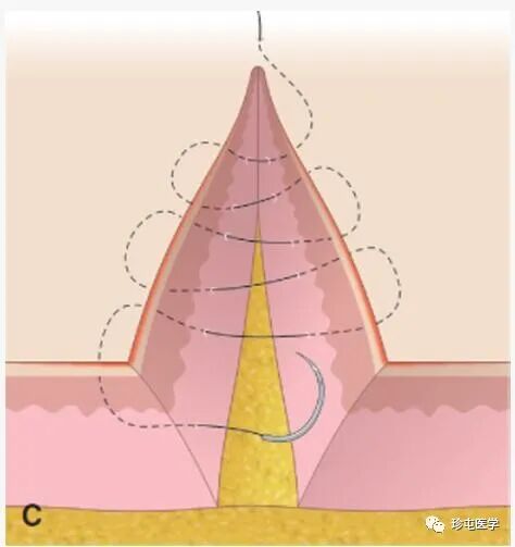 皮下缝合用什么线皮下缝合_https://www.jmylbn.com_新闻资讯_第8张