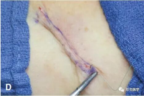 皮下缝合用什么线皮下缝合_https://www.jmylbn.com_新闻资讯_第9张