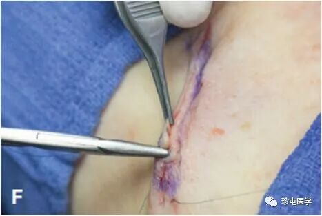皮下缝合用什么线皮下缝合_https://www.jmylbn.com_新闻资讯_第11张