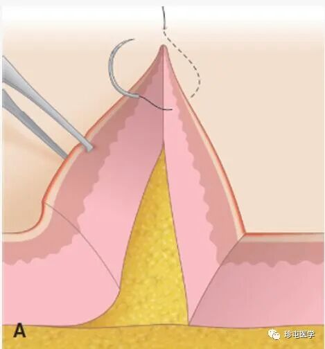 皮下缝合用什么线皮下缝合_https://www.jmylbn.com_新闻资讯_第6张