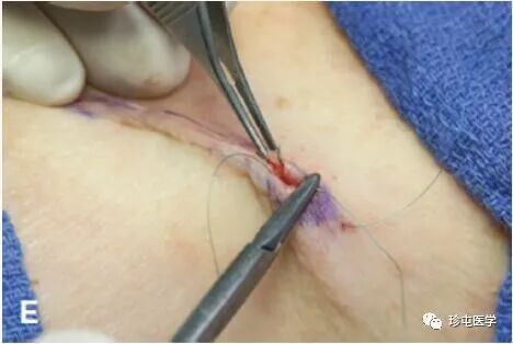 皮下缝合用什么线皮下缝合_https://www.jmylbn.com_新闻资讯_第10张