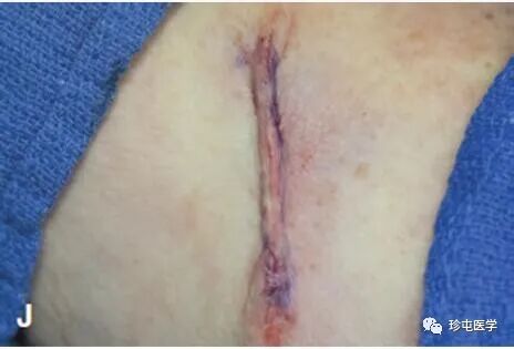 皮下缝合用什么线皮下缝合_https://www.jmylbn.com_新闻资讯_第15张