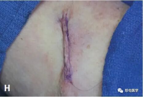 皮下缝合用什么线皮下缝合_https://www.jmylbn.com_新闻资讯_第13张