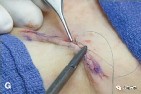 皮下缝合用什么线皮下缝合_https://www.jmylbn.com_新闻资讯_第12张