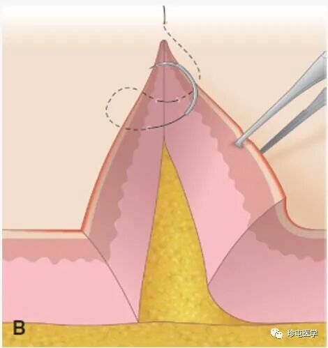 皮下缝合用什么线皮下缝合_https://www.jmylbn.com_新闻资讯_第7张