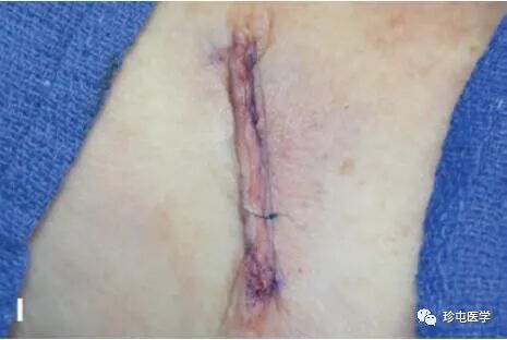 皮下缝合用什么线皮下缝合_https://www.jmylbn.com_新闻资讯_第14张