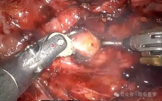 什么是可吸收夹机器人输尿管重建不可吸收夹侵蚀输尿管_https://www.jmylbn.com_新闻资讯_第5张