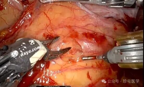 什么是可吸收夹机器人输尿管重建不可吸收夹侵蚀输尿管_https://www.jmylbn.com_新闻资讯_第3张