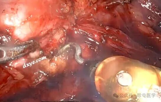 什么是可吸收夹机器人输尿管重建不可吸收夹侵蚀输尿管_https://www.jmylbn.com_新闻资讯_第8张