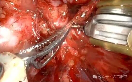 什么是可吸收夹机器人输尿管重建不可吸收夹侵蚀输尿管_https://www.jmylbn.com_新闻资讯_第6张