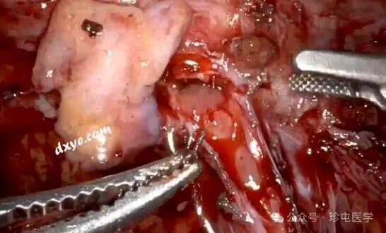 什么是可吸收夹机器人输尿管重建不可吸收夹侵蚀输尿管_https://www.jmylbn.com_新闻资讯_第13张