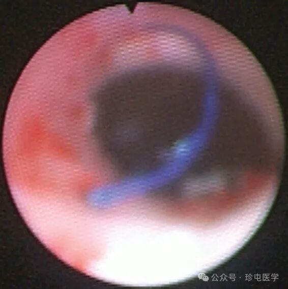 什么是可吸收夹机器人输尿管重建不可吸收夹侵蚀输尿管_https://www.jmylbn.com_新闻资讯_第18张