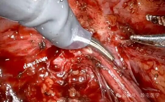 什么是可吸收夹机器人输尿管重建不可吸收夹侵蚀输尿管_https://www.jmylbn.com_新闻资讯_第12张