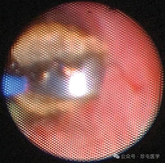 什么是可吸收夹机器人输尿管重建不可吸收夹侵蚀输尿管_https://www.jmylbn.com_新闻资讯_第17张