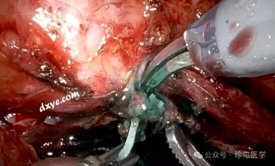 什么是可吸收夹机器人输尿管重建不可吸收夹侵蚀输尿管_https://www.jmylbn.com_新闻资讯_第11张