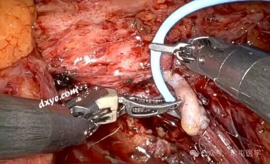 什么是可吸收夹机器人输尿管重建不可吸收夹侵蚀输尿管_https://www.jmylbn.com_新闻资讯_第14张