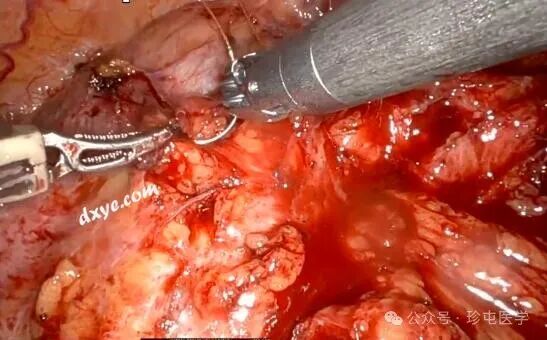 什么是可吸收夹机器人输尿管重建不可吸收夹侵蚀输尿管_https://www.jmylbn.com_新闻资讯_第4张