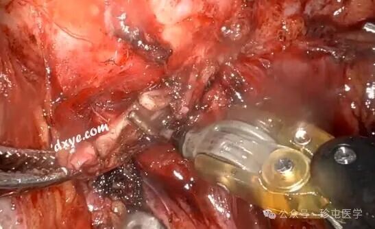 什么是可吸收夹机器人输尿管重建不可吸收夹侵蚀输尿管_https://www.jmylbn.com_新闻资讯_第9张