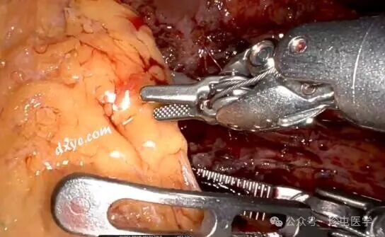 什么是可吸收夹机器人输尿管重建不可吸收夹侵蚀输尿管_https://www.jmylbn.com_新闻资讯_第15张