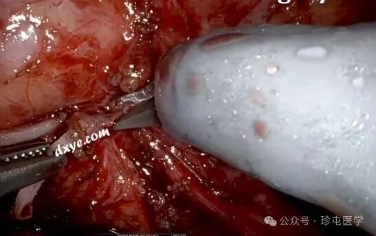 什么是可吸收夹机器人输尿管重建不可吸收夹侵蚀输尿管_https://www.jmylbn.com_新闻资讯_第10张