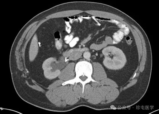 什么是可吸收夹机器人输尿管重建不可吸收夹侵蚀输尿管_https://www.jmylbn.com_新闻资讯_第16张