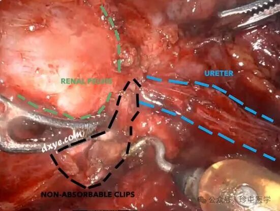 什么是可吸收夹机器人输尿管重建不可吸收夹侵蚀输尿管_https://www.jmylbn.com_新闻资讯_第7张