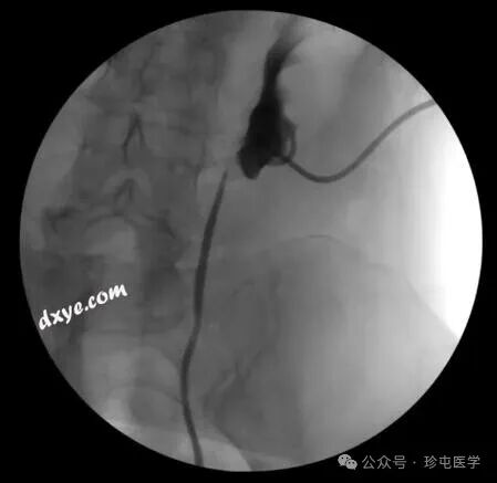 什么是可吸收夹机器人输尿管重建不可吸收夹侵蚀输尿管_https://www.jmylbn.com_新闻资讯_第1张