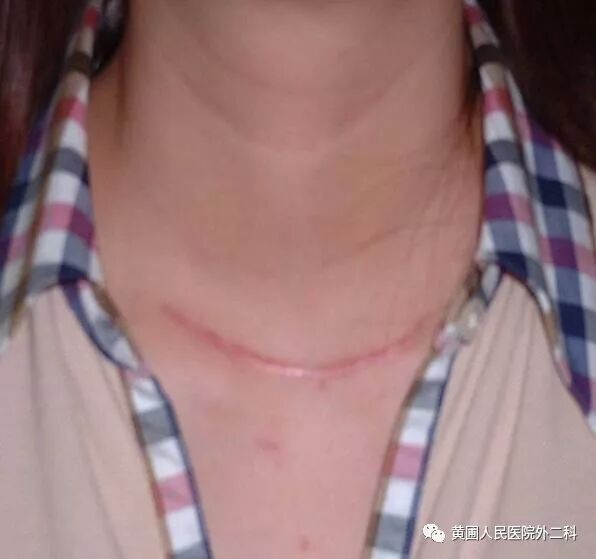et是是什么手术甲状腺手术的术式选择-上海聚慕医疗器械有限公司