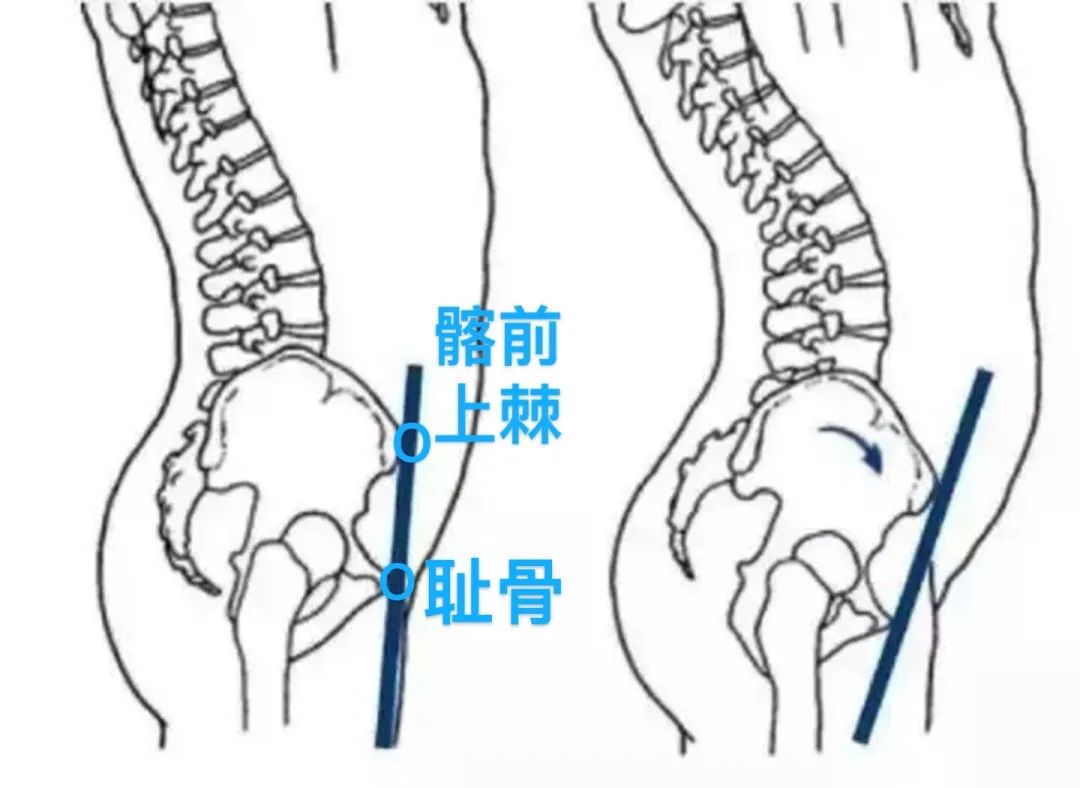 是基本在一条垂线上的。一旦髂前上棘过分向前突出，那就是骨盆前倾了。道理明白了，但这种 x 光式的鉴定方法对普通人太难，日常生活中如何检测