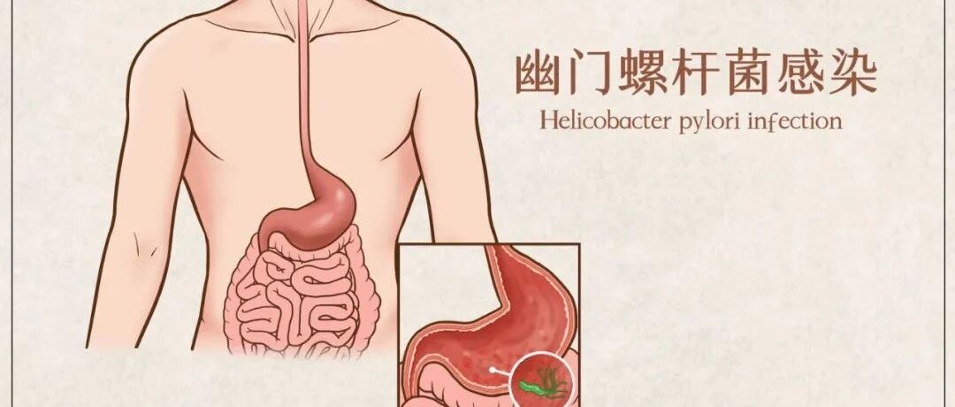 接吻容易传染幽门螺杆菌是真的吗？4个误区一定要清楚