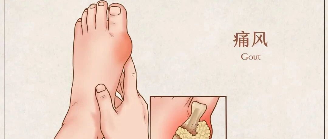 尿酸高是不是说明患了痛风？是否需要用药？