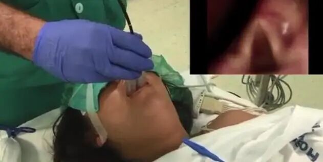 为什么要用喉罩i-gel喉罩的临床应用之无痛纤支镜诊疗_https://www.jmylbn.com_新闻资讯_第13张