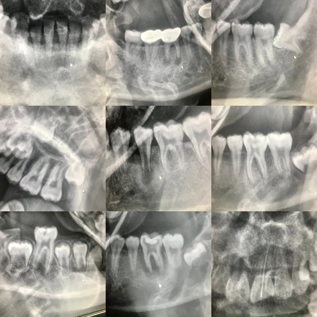 口腔ct怎么拍摄口腔全景CT落户阳山镇卫生院，看牙更精准、更高效_https://www.jmylbn.com_新闻资讯_第3张