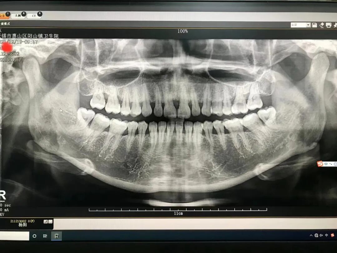 口腔ct怎么拍摄口腔全景CT落户阳山镇卫生院，看牙更精准、更高效_https://www.jmylbn.com_新闻资讯_第4张