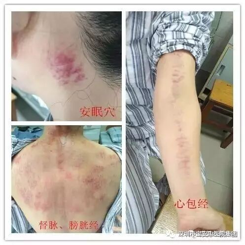 一种疗效显著的刮痧法——虎符铜砭刮痧_深圳市宝安中医院（集团）