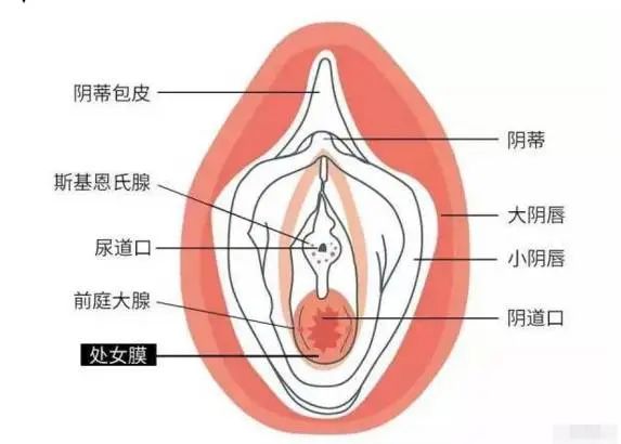 【健康科普】肿胀疼痛——妇科常见急症之“前庭大腺囊肿”