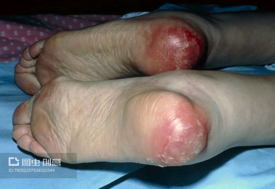 什么病忌用翻身床为什么使用气垫床时，患者还要 q2 h 翻身吗？_https://www.jmylbn.com_新闻资讯_第2张