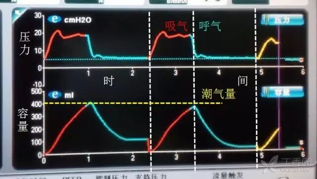 呼吸机f什么意思临床 ｜ 护士碰到呼吸机参数，不再慌！_https://www.jmylbn.com_新闻资讯_第2张