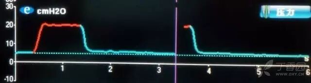 呼吸机f什么意思临床 ｜ 护士碰到呼吸机参数，不再慌！_https://www.jmylbn.com_新闻资讯_第4张