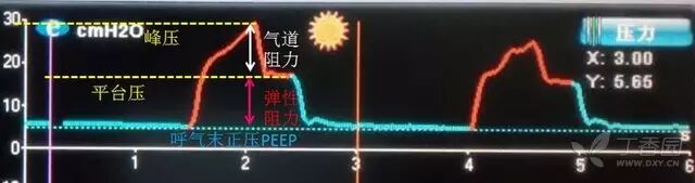 呼吸机f什么意思临床 ｜ 护士碰到呼吸机参数，不再慌！_https://www.jmylbn.com_新闻资讯_第3张