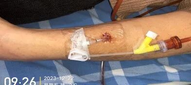 为什么国外不用y型留置针价格留置针一定要 U 型固定吗？这样做才是最合适的_https://www.jmylbn.com_新闻资讯_第5张