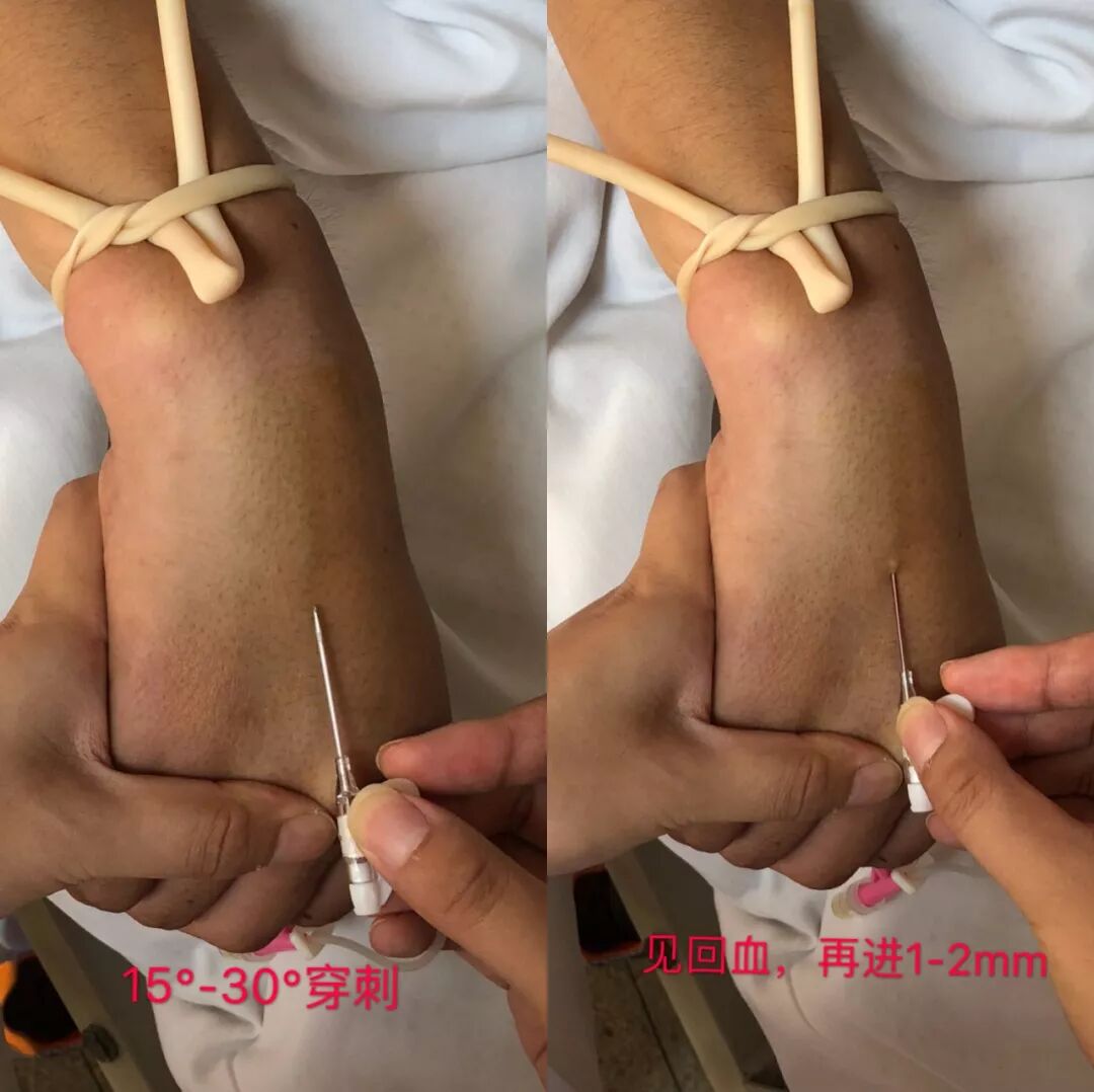 留置针怎么单手推针留置针穿刺：真人示范，四步掌握单手退针法_https://www.jmylbn.com_新闻资讯_第4张