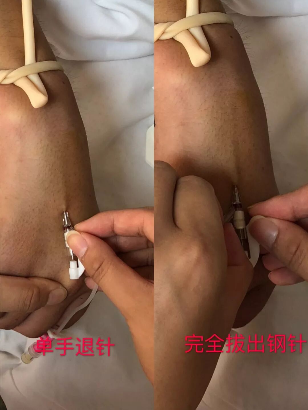 留置针怎么单手推针留置针穿刺：真人示范，四步掌握单手退针法_https://www.jmylbn.com_新闻资讯_第6张