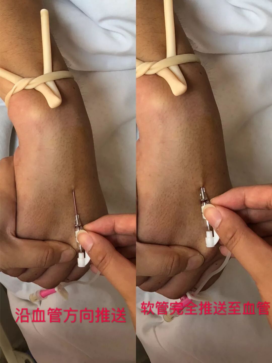 留置针怎么单手推针留置针穿刺：真人示范，四步掌握单手退针法_https://www.jmylbn.com_新闻资讯_第5张