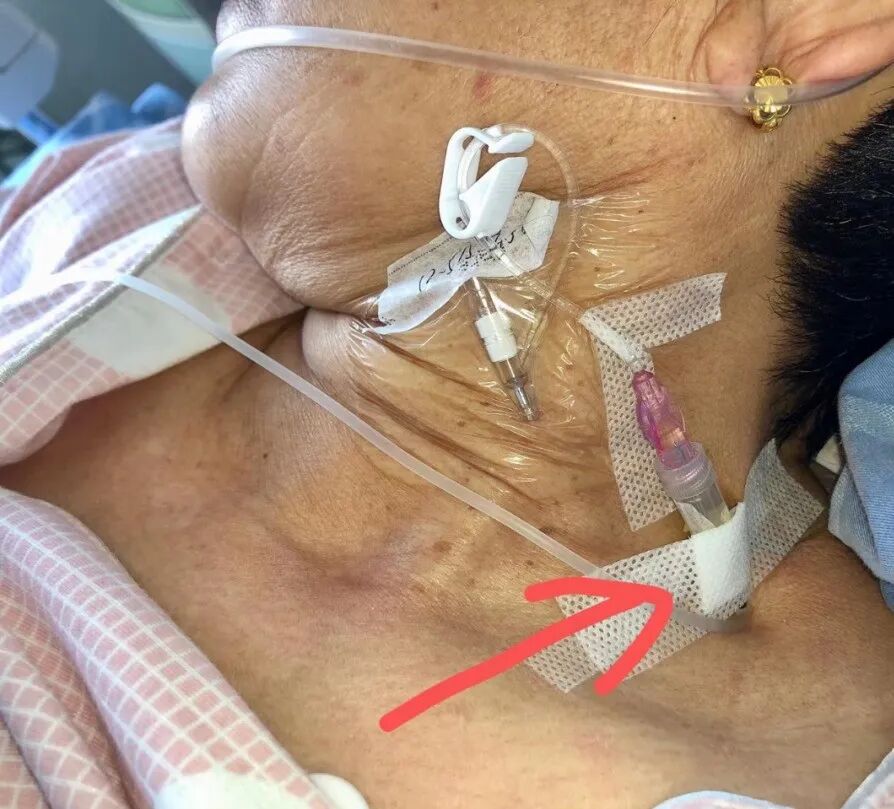 bd留置针怎么使用病人都休克了，留置针打不上怎么办？教你一招！_https://www.jmylbn.com_新闻资讯_第6张