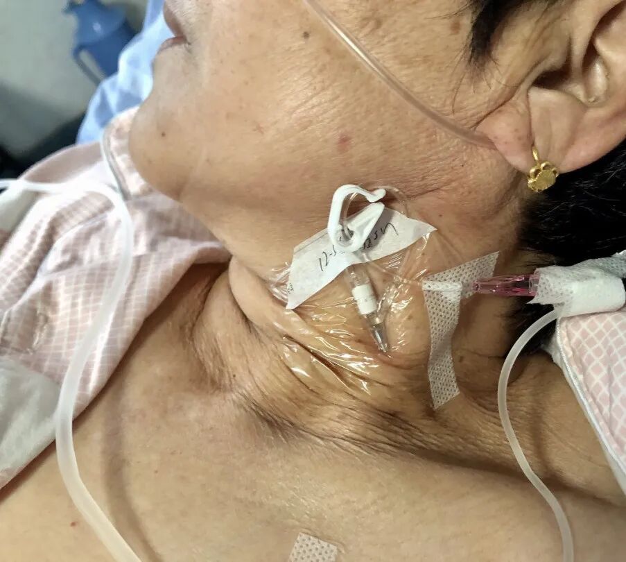 bd留置针怎么使用病人都休克了，留置针打不上怎么办？教你一招！_https://www.jmylbn.com_新闻资讯_第7张